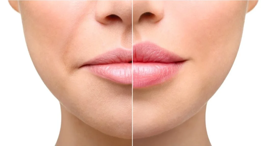 Dermal Fillers