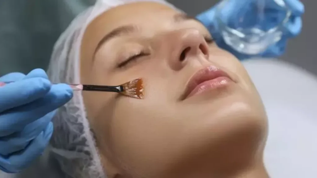 Chemical Peels